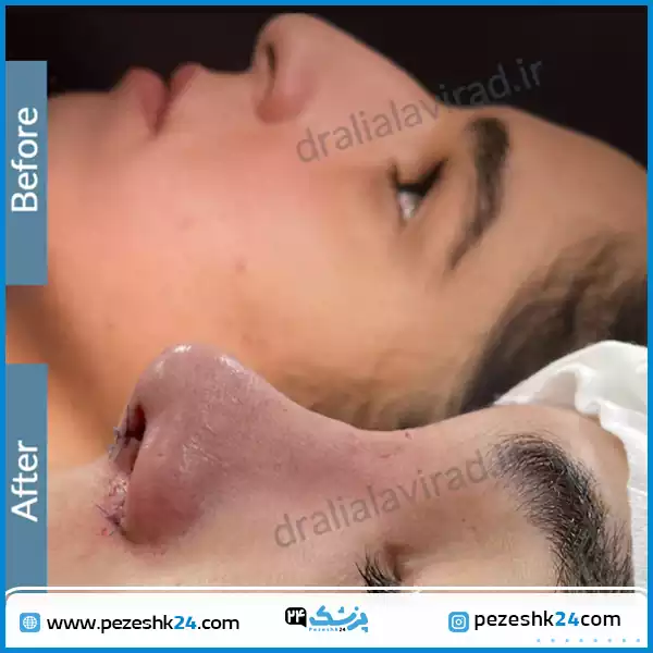 قبل و بعد عمل بینی فانتزی دکتر علوی راد اصفهان
