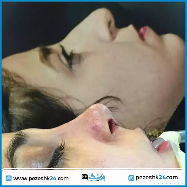 قبل و بعد عمل بینی عروسکی دکتر علوی راد اصفهان