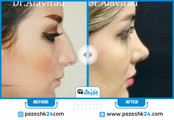 قبل و بعد عمل بینی عروسکی دکتر علوی راد