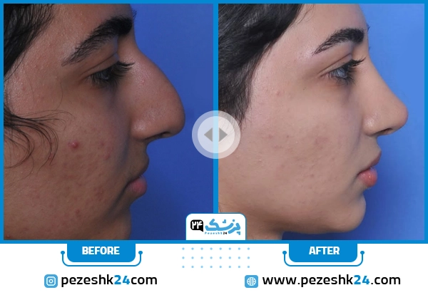 قبل و بعد عمل زیبایی بینی دکتر سرکارات