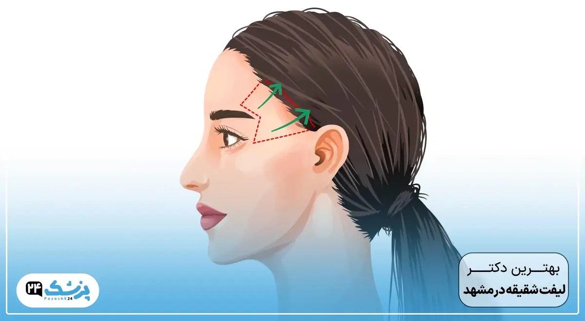 بهترین جراح لیفت شقیقه در مشهد