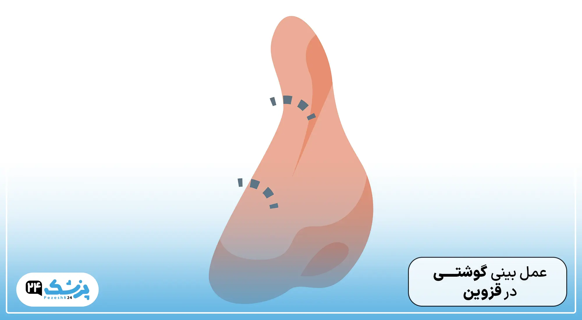 عمل بینی گوشتی در قزوین