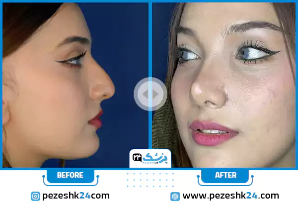 عکس قبل و بعد عمل بینی دکتر اکبریان در مشهد