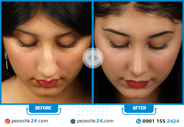 قبل و بعد نمونه عمل بینی با انحراف