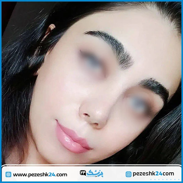 نمونه عمل بینی دکتر معین شیراز