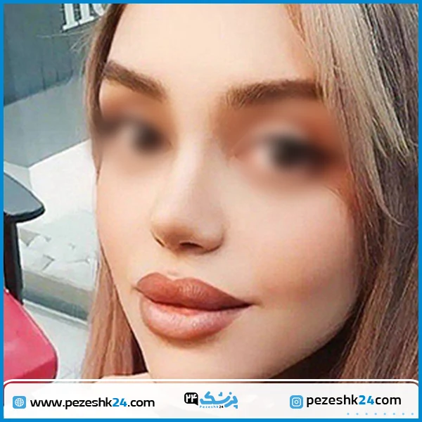 نمونه عمل زیبایی بینی دکتر معین شیراز