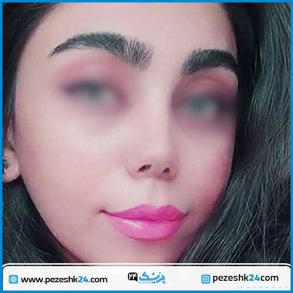 نمونه جراحی زیبایی بینی دکتر معین