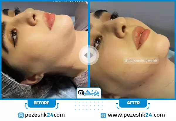 قبل و بعد از لیپوساکشن غبغب دکتر باوندی