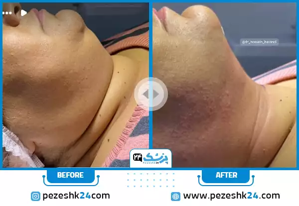 قبل و بعد از جراحی غبغب و فرمدهی صورت توسط دکتر باوندی