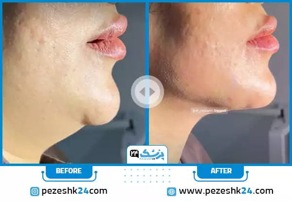قبل و بعد از عمل لیپوساکشن غبغب و تغییر زاویه فک دکتر باوندی