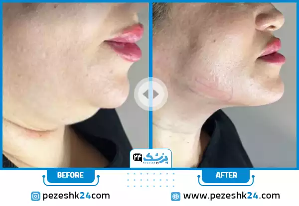 قبل و بعد ساکشن غبغب و و چانه دکتر باوندی
