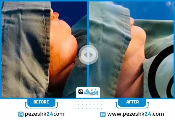 نتایج قبل و بعد از جراحی غبغب؛ زاویهسازی طبیعی فک با دکتر جعفری