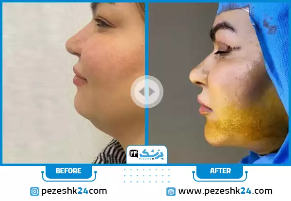 قبل و بعد از جراحی غبغب و زاویهسازی فک توسط دکتر جعفری