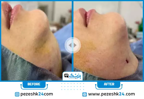 قبل و بعد از جراحی غبغب صورت توسط دکتر جعفری