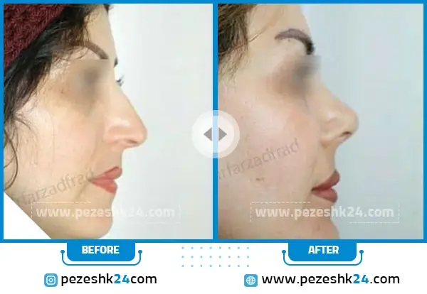 نمونه کار قبل و بعد عمل بینی نوک گرد دکتر اسماعیل فرزادفرد در مشهد