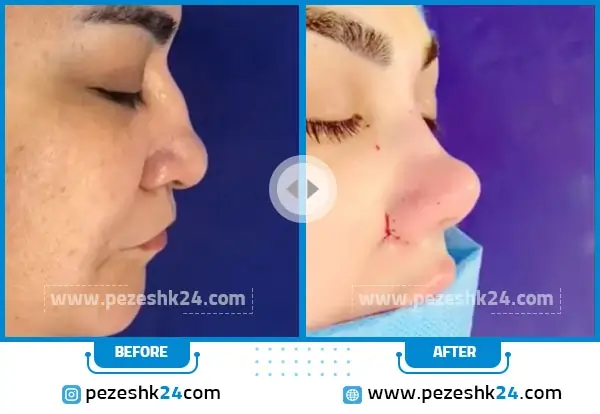 نمونه کار قبل و بعد عمل بینی گوشتی استخوانی دکتر اسماعیل فرزادفرد در مشهد