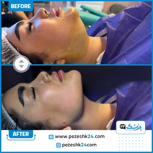 نمونه کار قبل و بعد جراحی غبغب دکتر نوید زارعی در مشهد