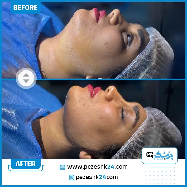 عکس قبل و بعد ساکشن غبغب و خط وی توسط دکتر نوید زارعی در مشهد
