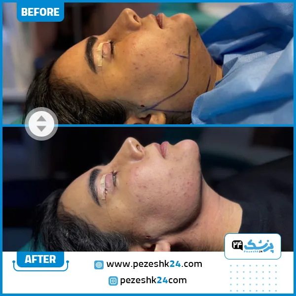 عکس قبل و بعد رفع غبغب دکتر نوید زارعی در مشهد