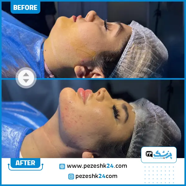 نمونه کار قبل و بعد ساکشن غبغب دکتر نوید زارعی در مشهد