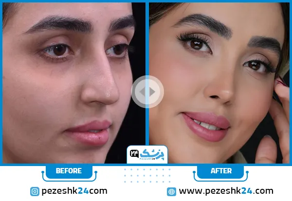 نمونه عمل بینی بدون تامپون دکتر ارژنگ تهران