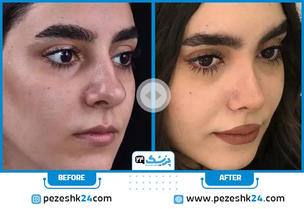 نمونه عمل زیبایی بینی بدون تامپون دکتر ارژنگ