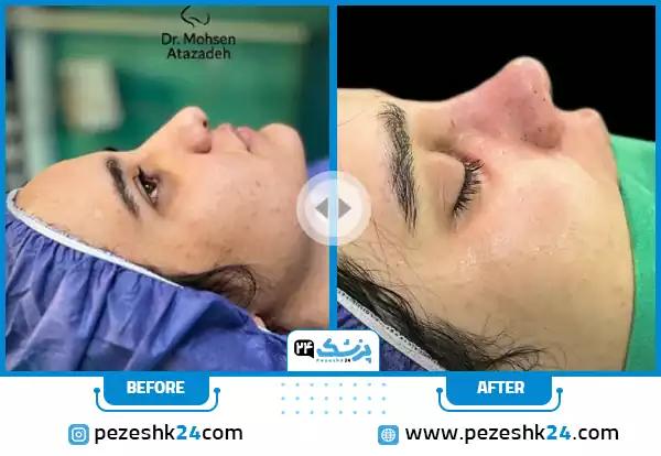 نمونه عمل بینی دکتر عطازاده کرج