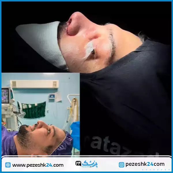 نمونه عمل بینی دکتر عطازاده در کرج