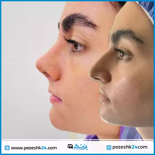 نمونه جراحی بینی دکتر عطازاده در کرج