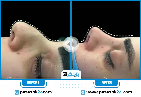 نمونه جراحی بینی دکتر عطازاده کرج