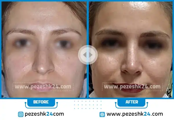 قبل و بعد رینوپلاستی دکتر اکبریان