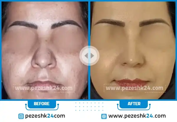 قبل و بعد جراحی بینی دکتر محمد اکبریان
