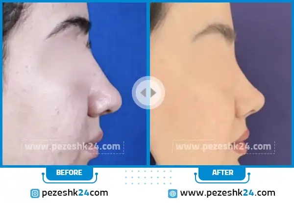 قبل و بعد جراحی بینی دکتر اکبریان