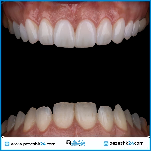 قبل و بعد ونیر کامپوزیت دکتر کیان حقیقی