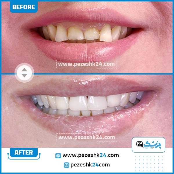قبل وبعد کامپوزیت بهترین دندانپزشک دکتر مریم سادات پوراحمدی در تهران