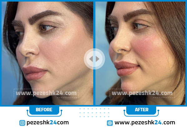 قبل و بعد ژل لب دکتر ابوالفضل حکیم پور