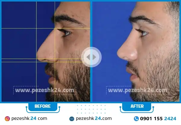 قبل و بعد عمل بینی طبیعی دکتر عرفانیان