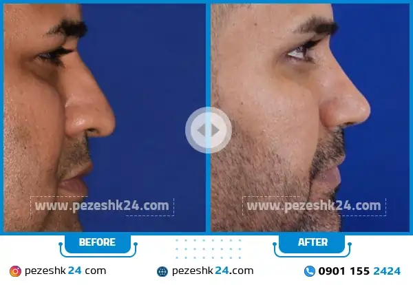 قبل و بعد عمل بینی طبیعی دکتر عرفانیان مشهد