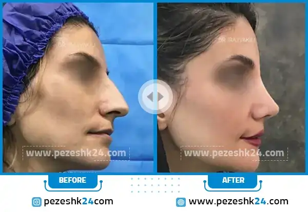 قبل و بعد جراحی بینی دکتر ایرج وکیلی در مشهد