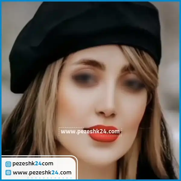 نمونه جراحی بینی دکتر ایرج وکیلی