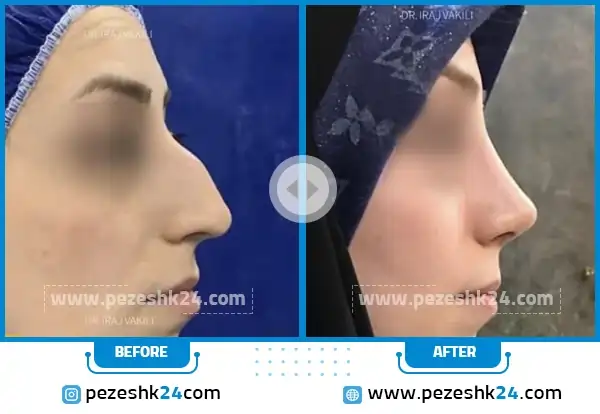 عکس قبل و بعد جراحی بینی دکتر ایرج وکیلی مشهد