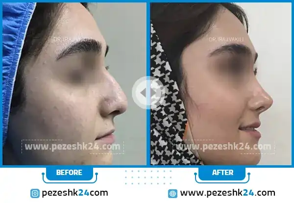 عکس قبل و بعد عمل بینی دکتر ایرج وکیلی