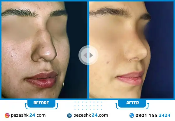 نمونه قبل و بعد عمل بینی دکتر اکبریان