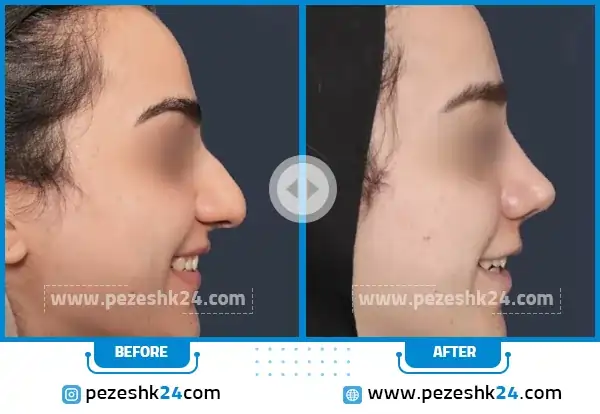 قبل و بعد عمل بینی دکتر کریم جلائیان مشهد
