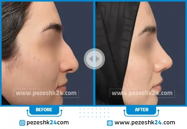 قبل و بعد جراحی بینی دکتر کریم جلائیان