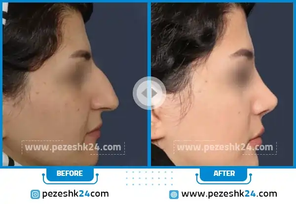 قبل و بعد رینوپلاستی دکتر کریم جلائیان