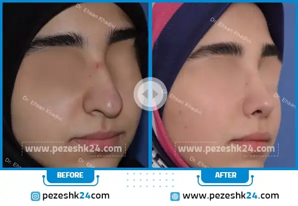 قبل و بعد جراحی بینی دکتر خدیوی
