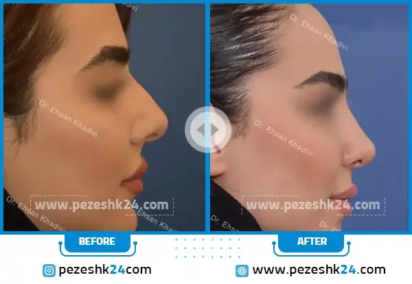 قبل و بعد رینوپلاستی دکتر خدیوی مشهد