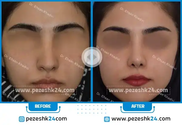 قبل و بعد عمل بینی احسان خدیوی