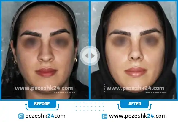 جراحی بینی دکتر تیموری